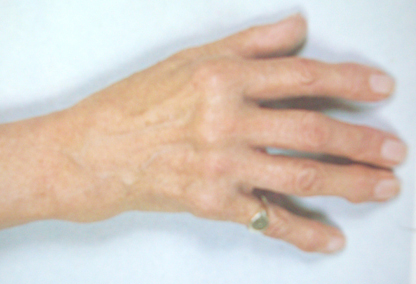 Rheumatoid Arthritis Ayurvedic Treatment in Bhuj at Royal Ayurveda