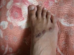 Right foot of Vimal after one month treatment