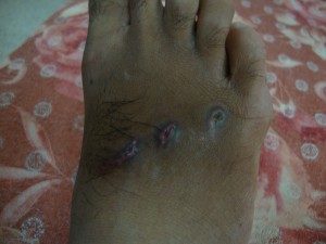 Right foot of Vimal after one week treatment (1)