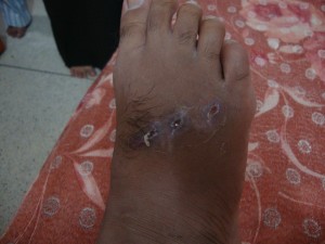 Right foot of Vimal before treatment