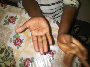 Abul Swala's left hand before treatment