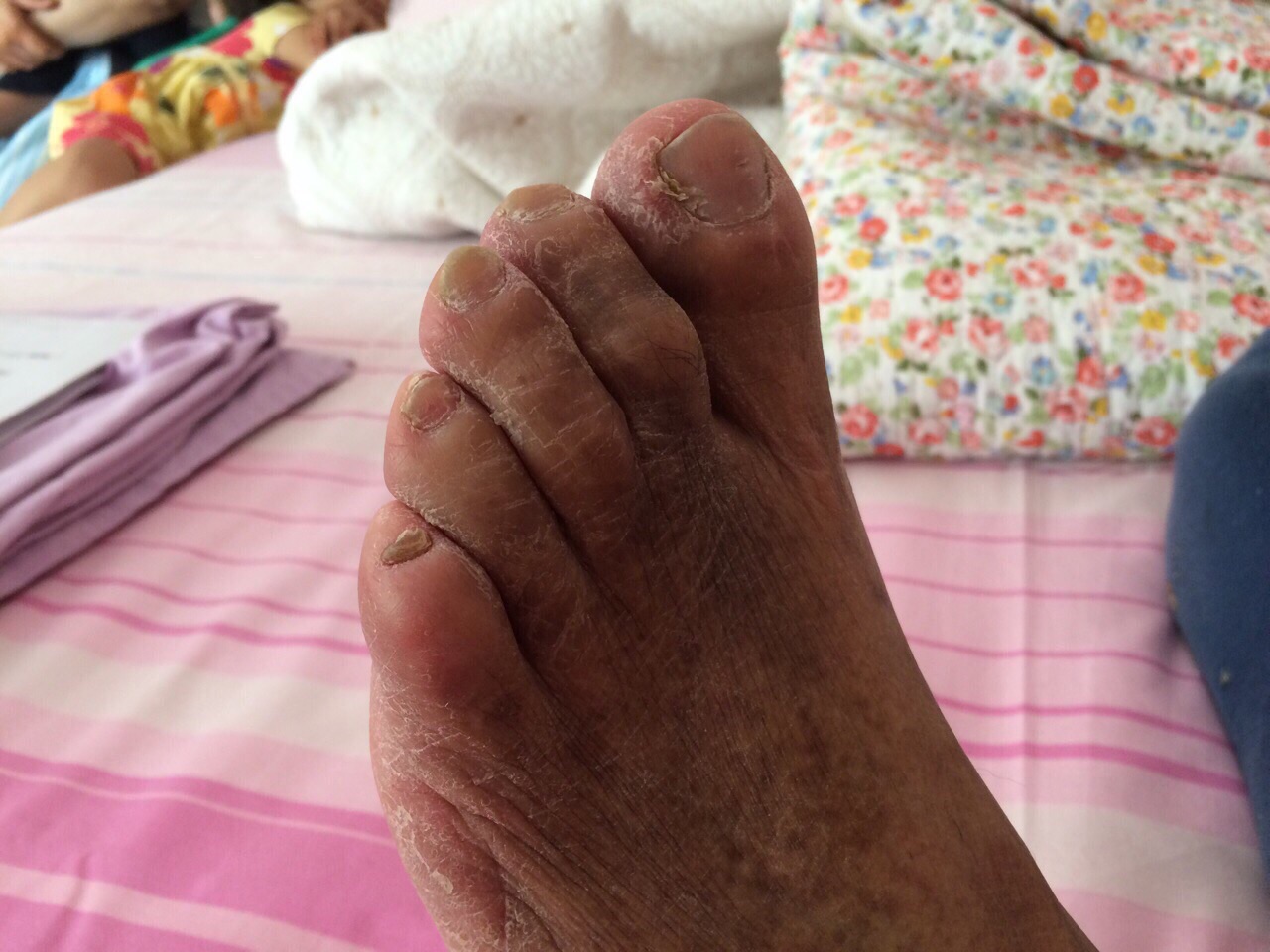 diabetic feet itch